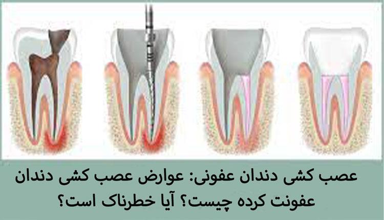 مراحل عصب کشی دندان عفونی