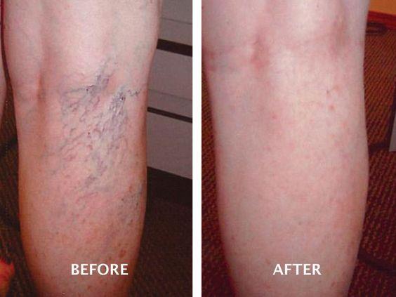 قبل و بعد از درمان واریس پشت ساق پا 