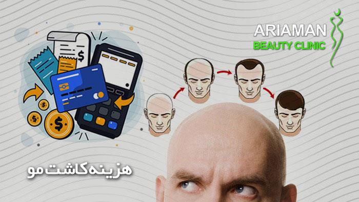 هزینه کاشت مو در ایران