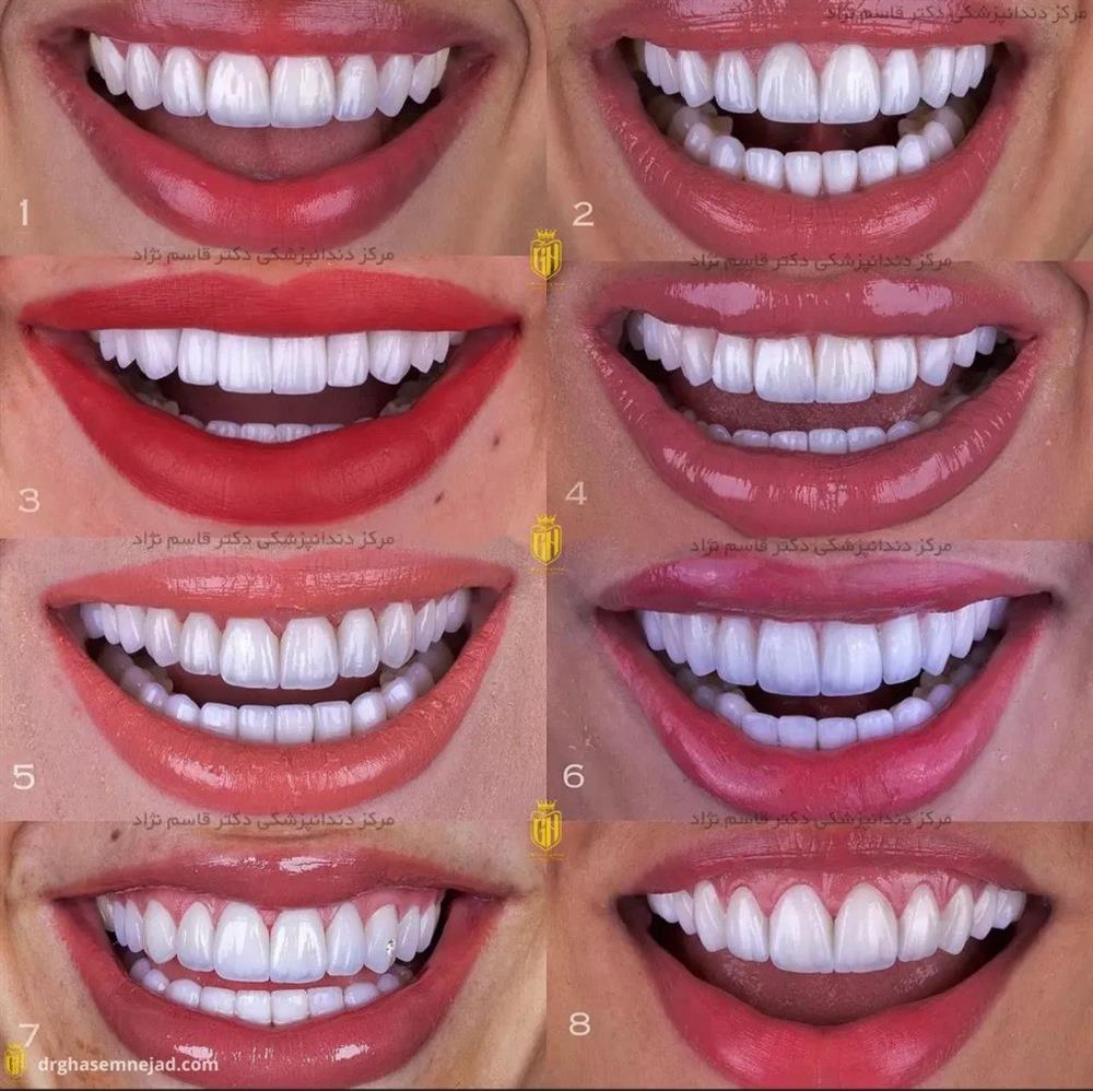 نمونه لمینت دندان لبه شیشه ای ایمکس