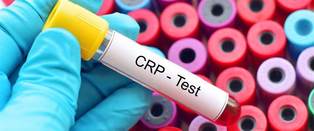 آزمایش CRP برای تشخیص التهاب و عفونت در بدن انجام می‌شود