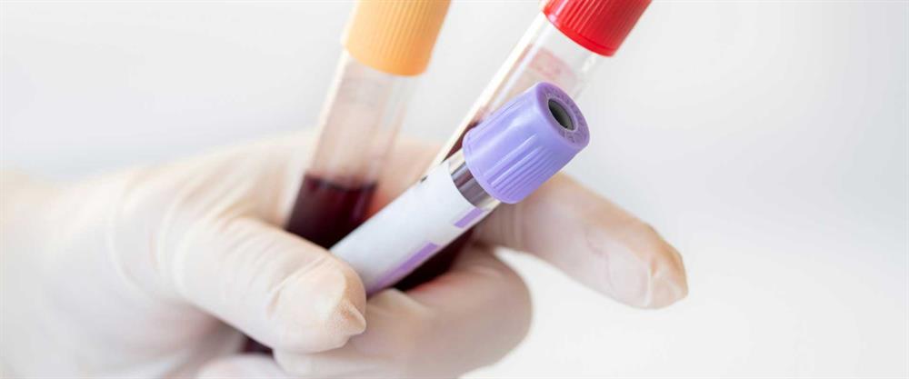 آزمایش خون کامل برای تشخیص بیماری‌ها انجام می‌شود