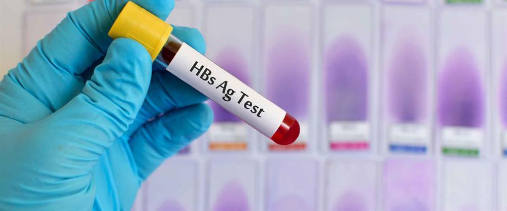 آزمایش HBsAG برای بررسی وجود ویروس هپاتیت B در بدن تجویز می‌شود