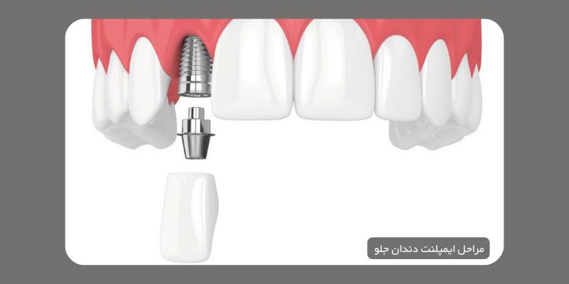 ایمپلنت دندان جلو در کلینیک دندانپزشکی موذن