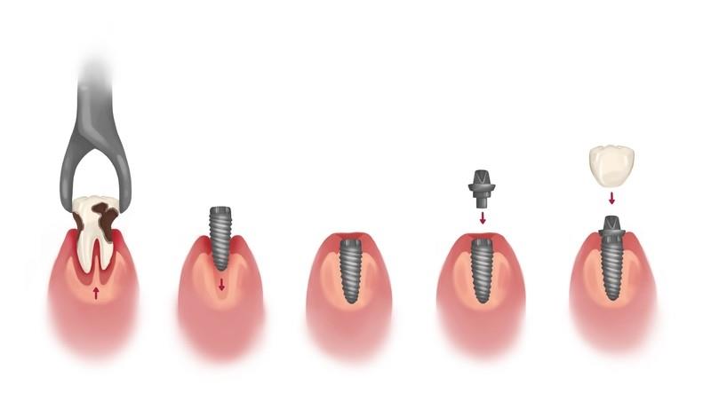 مراحل کاشت ایمپلنت دندان
