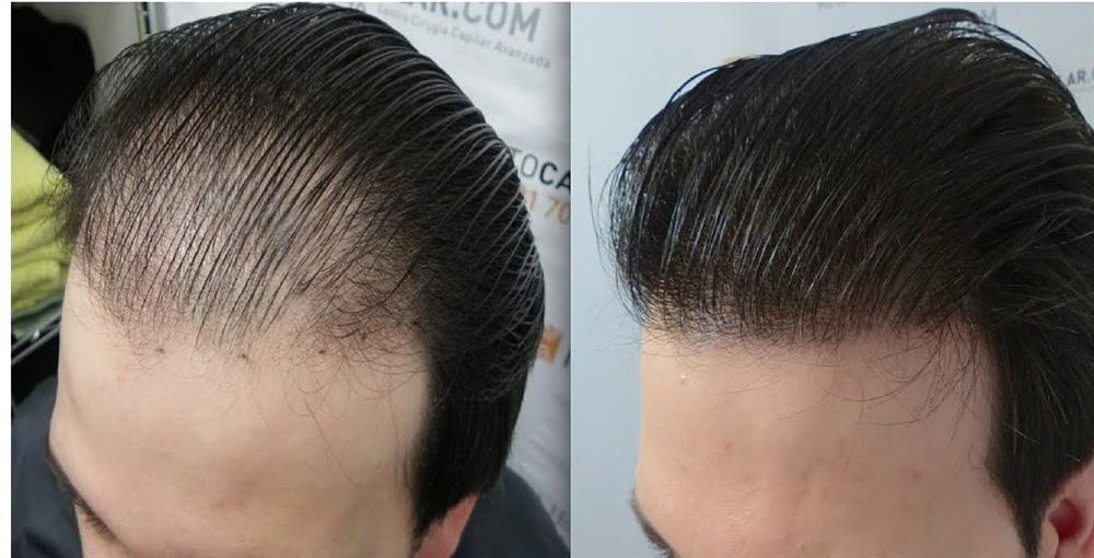 Is hair transplant safe Hair transplant complications